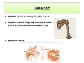 Biopsy sites
• Clavicle – parallel to the long axis of the clavicle.
• Scapula – over the line joining from supero-lateral
part of acromiom to inferior and medial angle
• Proximal humerus .
 
