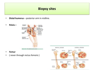 Biopsy sites
• Distal humerus – posterior arm in midline.
• Pelvis –
• Femur
• ( never through rectus femoris )
 
