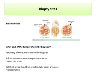 Biopsy sites
. Proximal tibia
What part of the tumour should be biopsied?
Periphery of the tumour should be biopsied
Soft tissue component is representative as
that of the bone
Calcified areas should be avoided, lytic areas are more
representative
 