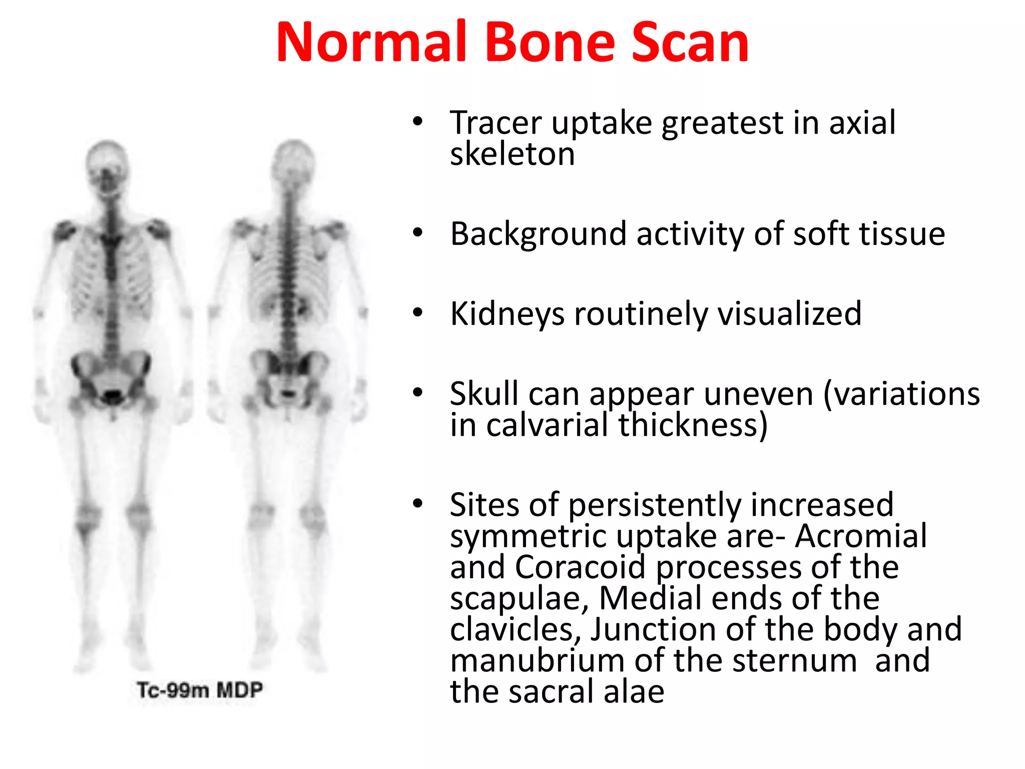 Normal Bone Scan
• Tracer uptake greatest in axial
skeleton
• Background activity of soft tissue
• Kidneys routinely visualized
• Skull can appear uneven (variations
in calvarial thickness)
• Sites of persistently increased
symmetric uptake are- Acromial
and Coracoid processes of the
scapulae, Medial ends of the
clavicles, Junction of the body and
manubrium of the sternum and
the sacral alae
 