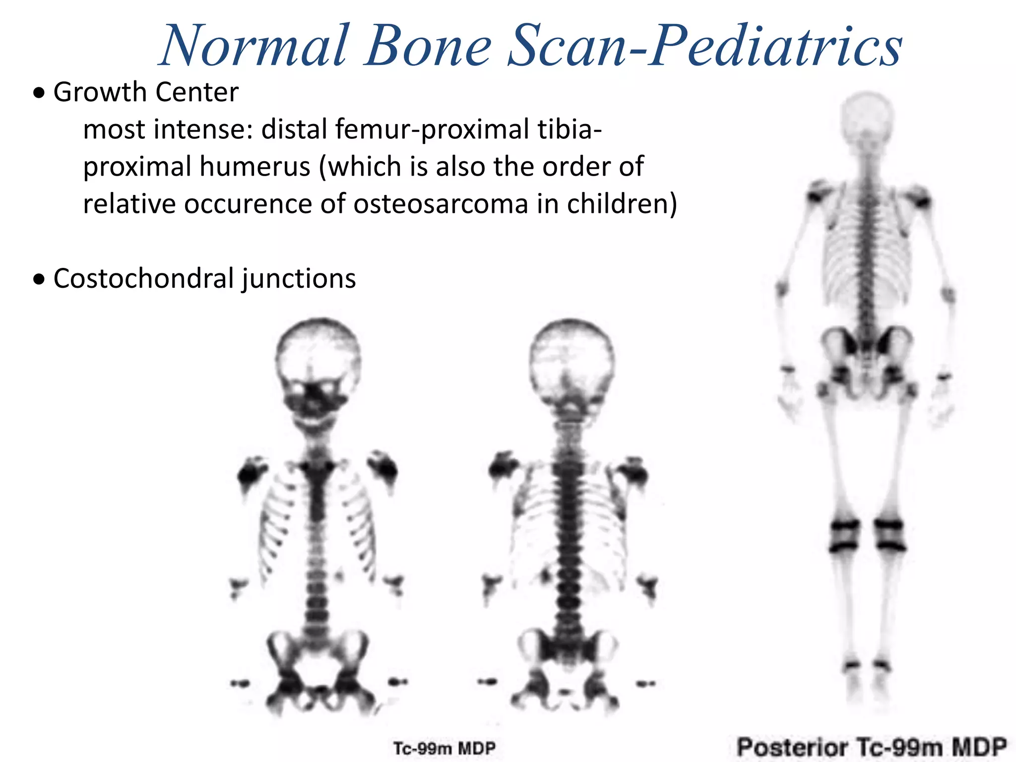 Normal Bone Scan-Pediatrics
 Growth Center
most intense: distal femur-proximal tibia-
proximal humerus (which is also the order of
relative occurence of osteosarcoma in children)
 Costochondral junctions
 