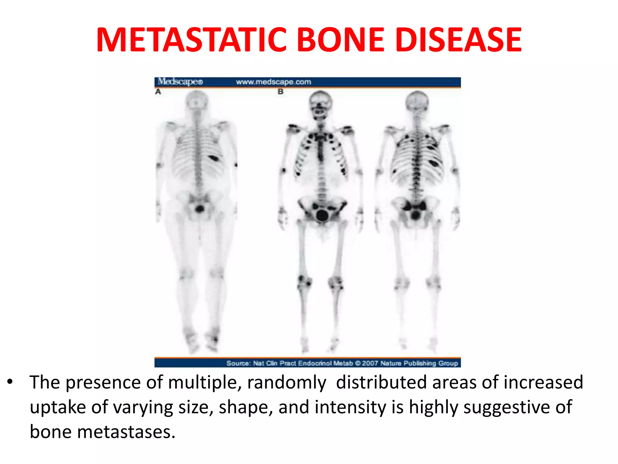 METASTATIC BONE DISEASE
• The presence of multiple, randomly distributed areas of increased
uptake of varying size, shape, and intensity is highly suggestive of
bone metastases.
 