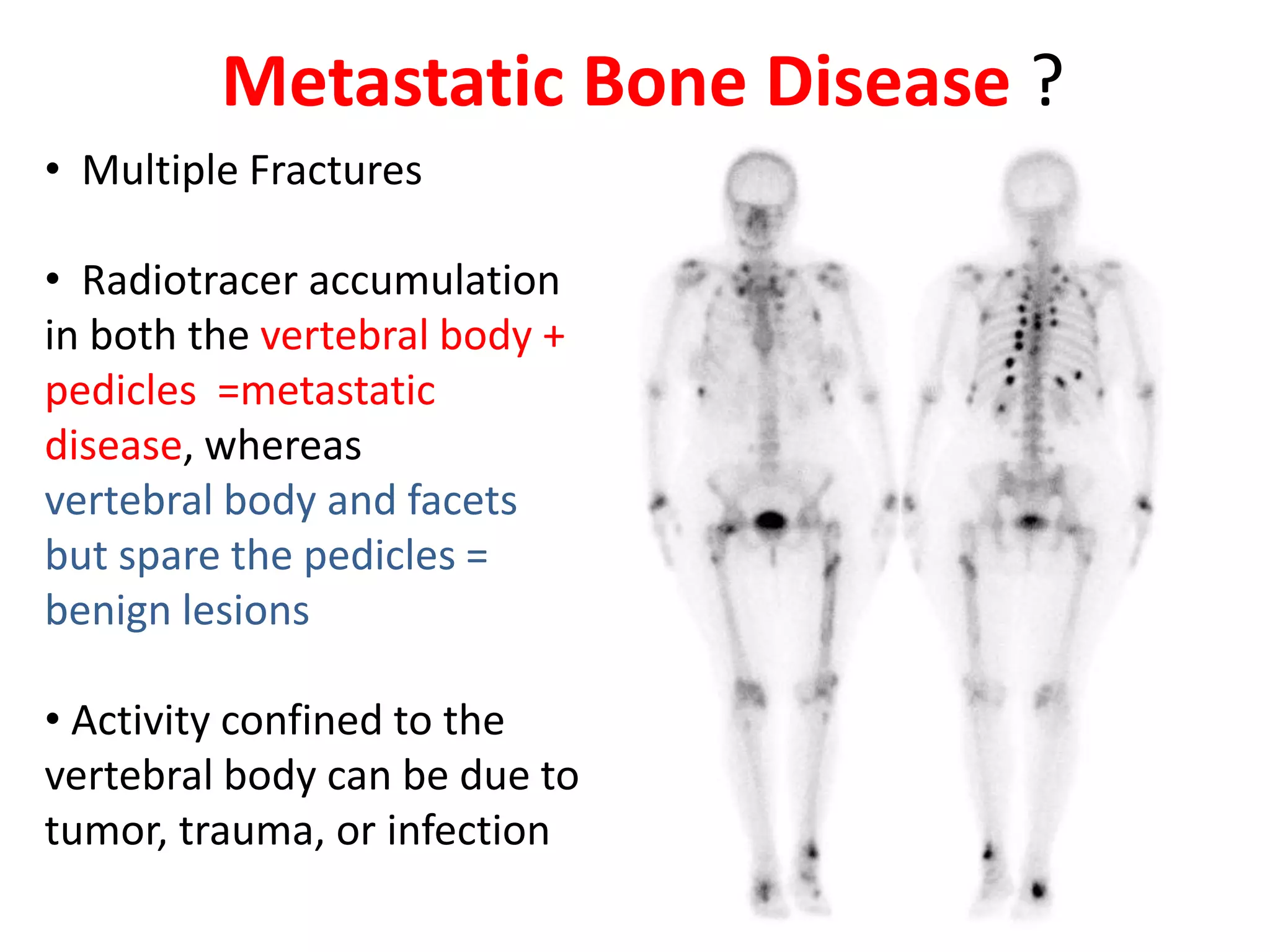 Metastatic Bone Disease ?
• Multiple Fractures
• Radiotracer accumulation
in both the vertebral body +
pedicles =metastatic
disease, whereas
vertebral body and facets
but spare the pedicles =
benign lesions
• Activity confined to the
vertebral body can be due to
tumor, trauma, or infection
 