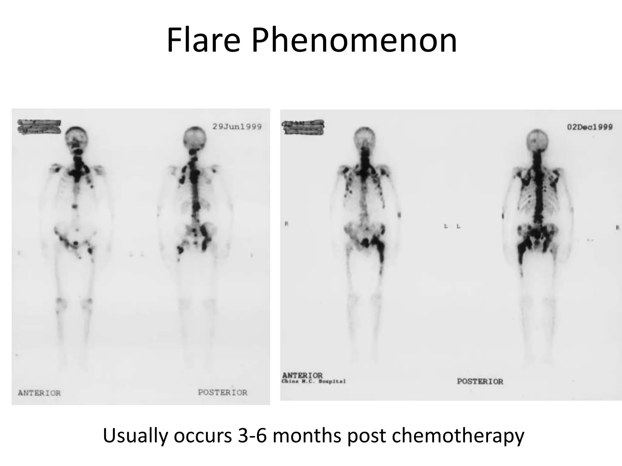 Flare Phenomenon
Usually occurs 3-6 months post chemotherapy
 