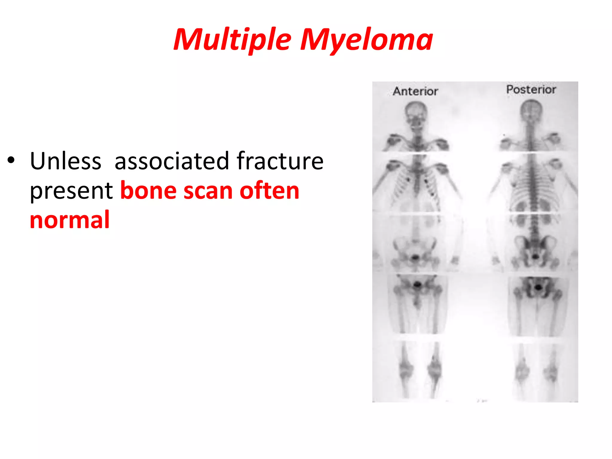 Multiple Myeloma
• Unless associated fracture
present bone scan often
normal
 