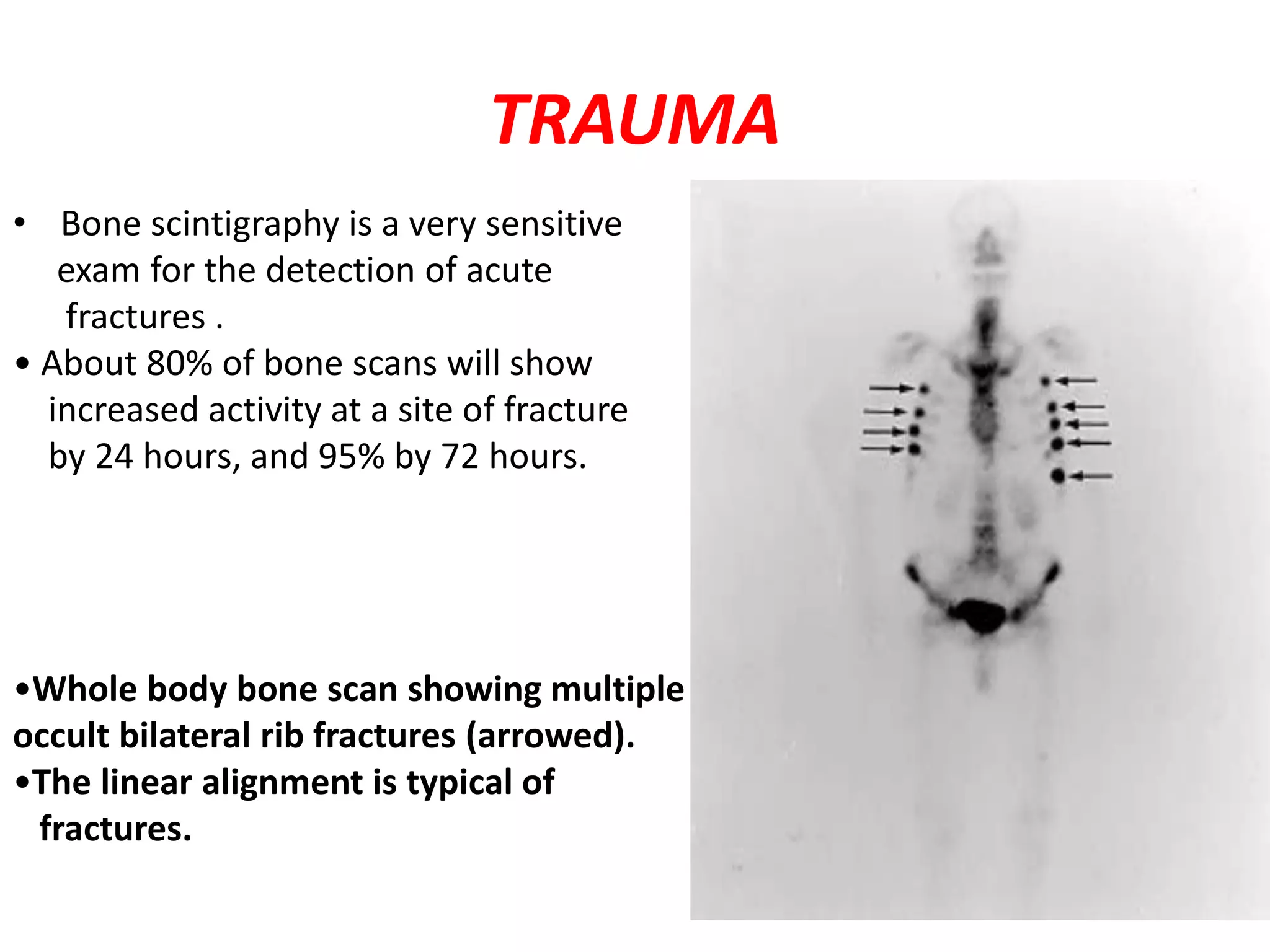 TRAUMA
• Bone scintigraphy is a very sensitive
exam for the detection of acute
fractures .
• About 80% of bone scans will show
increased activity at a site of fracture
by 24 hours, and 95% by 72 hours.
•Whole body bone scan showing multiple
occult bilateral rib fractures (arrowed).
•The linear alignment is typical of
fractures.
 