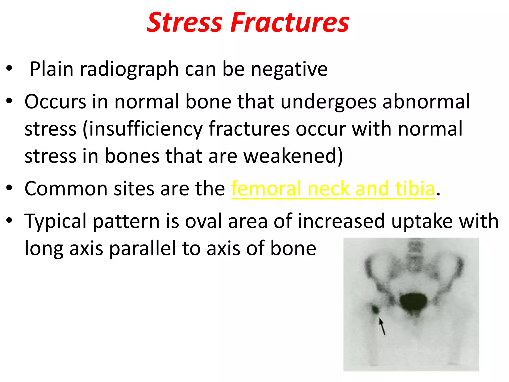 Stress Fractures
• Plain radiograph can be negative
• Occurs in normal bone that undergoes abnormal
stress (insufficiency fractures occur with normal
stress in bones that are weakened)
• Common sites are the femoral neck and tibia.
• Typical pattern is oval area of increased uptake with
long axis parallel to axis of bone
 