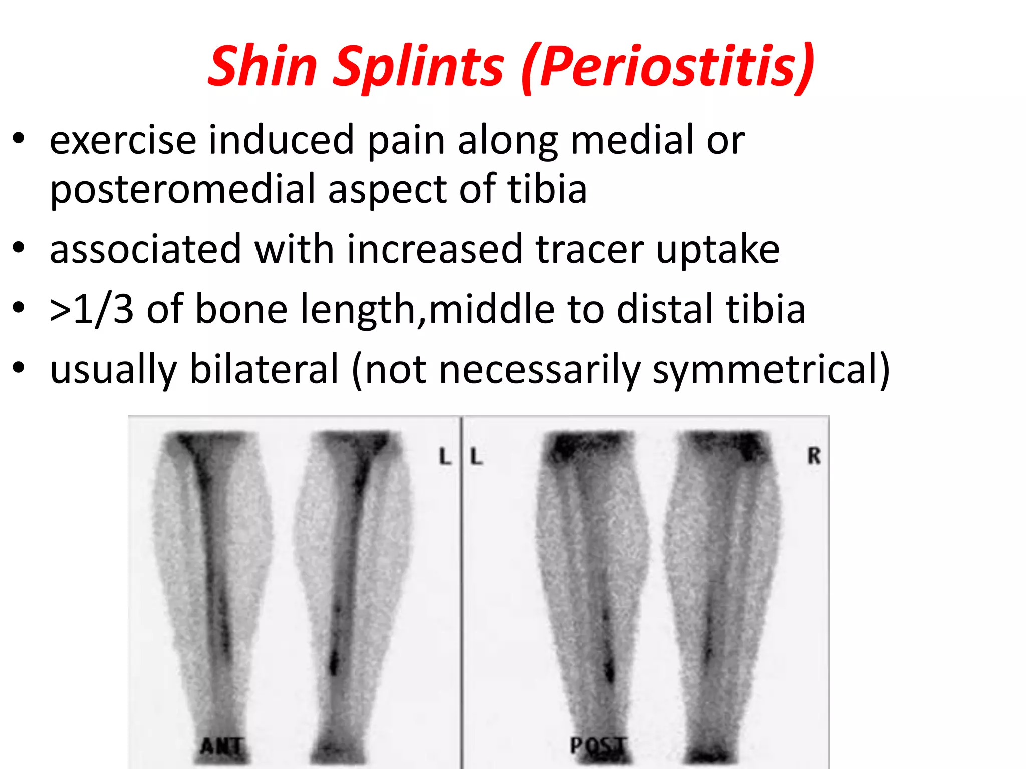 Shin Splints (Periostitis)
• exercise induced pain along medial or
posteromedial aspect of tibia
• associated with increased tracer uptake
• >1/3 of bone length,middle to distal tibia
• usually bilateral (not necessarily symmetrical)
 