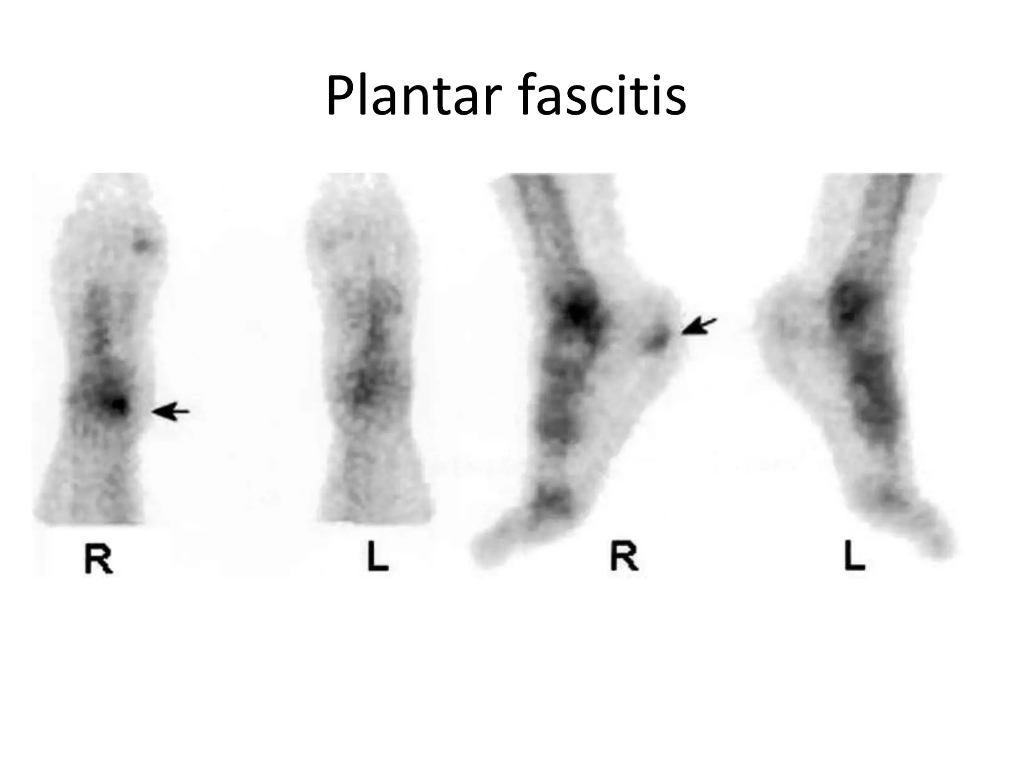 Plantar fascitis
 
