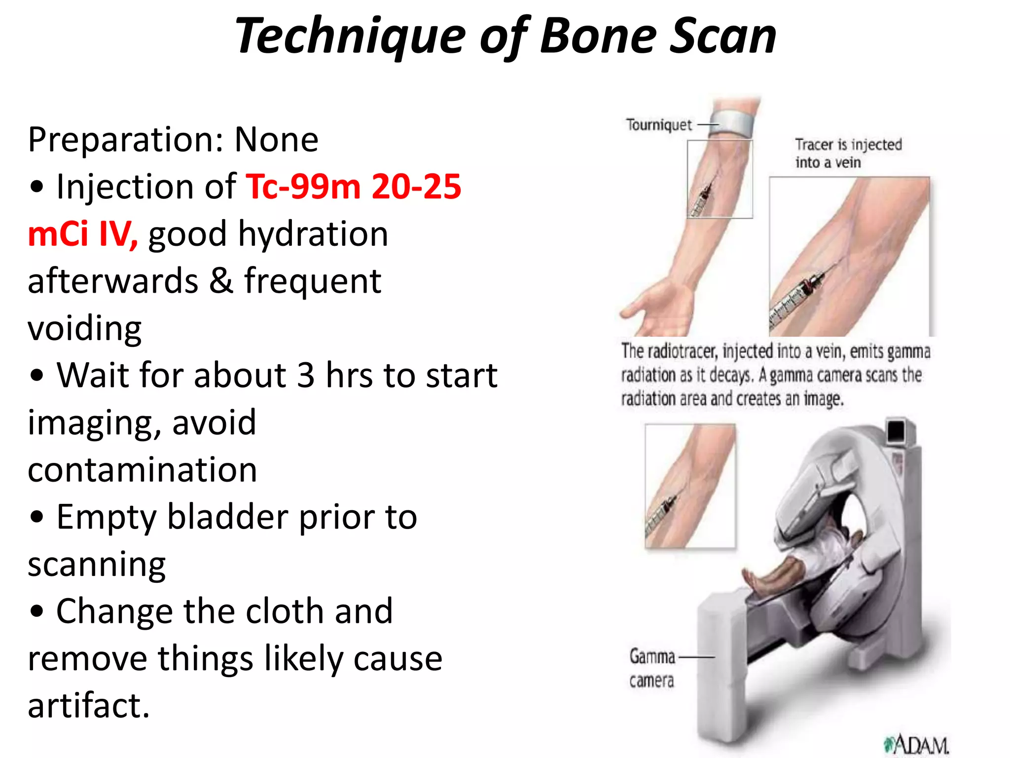 Technique of Bone Scan
Preparation: None
• Injection of Tc-99m 20-25
mCi IV, good hydration
afterwards & frequent
voiding
• Wait for about 3 hrs to start
imaging, avoid
contamination
• Empty bladder prior to
scanning
• Change the cloth and
remove things likely cause
artifact.
 