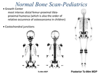 Normal Bone Scan-Pediatrics
 Growth Center
most intense: distal femur-proximal tibia-
proximal humerus (which is also the order of
relative occurence of osteosarcoma in children)
 Costochondral junctions
 
