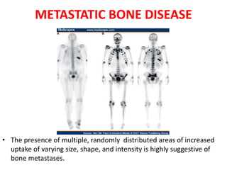METASTATIC BONE DISEASE
• The presence of multiple, randomly distributed areas of increased
uptake of varying size, shape, and intensity is highly suggestive of
bone metastases.
 