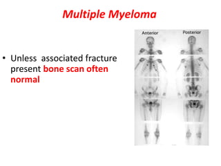 Multiple Myeloma
• Unless associated fracture
present bone scan often
normal
 