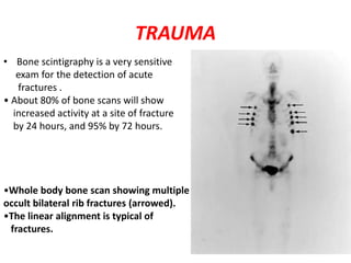 TRAUMA
• Bone scintigraphy is a very sensitive
exam for the detection of acute
fractures .
• About 80% of bone scans will show
increased activity at a site of fracture
by 24 hours, and 95% by 72 hours.
•Whole body bone scan showing multiple
occult bilateral rib fractures (arrowed).
•The linear alignment is typical of
fractures.
 