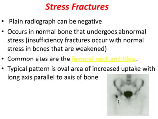Stress Fractures
• Plain radiograph can be negative
• Occurs in normal bone that undergoes abnormal
stress (insufficiency fractures occur with normal
stress in bones that are weakened)
• Common sites are the femoral neck and tibia.
• Typical pattern is oval area of increased uptake with
long axis parallel to axis of bone
 