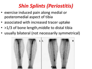 Shin Splints (Periostitis)
• exercise induced pain along medial or
posteromedial aspect of tibia
• associated with increased tracer uptake
• >1/3 of bone length,middle to distal tibia
• usually bilateral (not necessarily symmetrical)
 