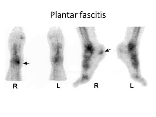 Plantar fascitis
 