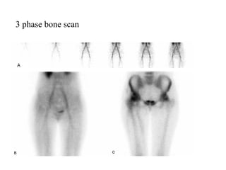 3 phase bone scan
 