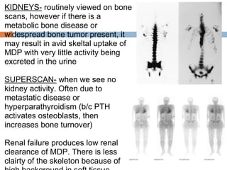 KIDNEYS- routinely viewed on bone
scans, however if there is a
metabolic bone disease or
widespread bone tumor present, it
may result in avid skeltal uptake of
MDP with very little activity being
excreted in the urine
 
SUPERSCAN- when we see no
kidney activity. Often due to
metastatic disease or
hyperparathyroidism (b/c PTH
activates osteoblasts, then
increases bone turnover)
 
Renal failure produces low renal
clearance of MDP. There is less
clairty of the skeleton because of
 