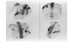 Multiple Rib Fractures. Vigorous osteoblastic
repair activity is seen in two rows of fractures, which were not
visible on radiographs.
 
