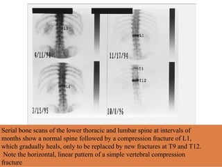 Serial bone scans of the lower thoracic and lumbar spine at intervals of
months show a normal spine followed by a compression fracture of L1,
which gradually heals, only to be replaced by new fractures at T9 and T12.
Note the horizontal, linear pattern of a simple vertebral compression
fracture
 