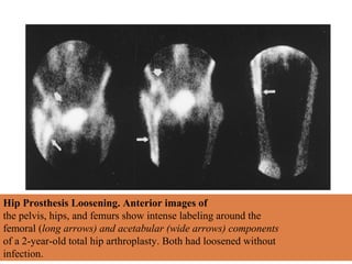 Hip Prosthesis Loosening. Anterior images of
the pelvis, hips, and femurs show intense labeling around the
femoral (long arrows) and acetabular (wide arrows) components
of a 2-year-old total hip arthroplasty. Both had loosened without
infection.
 