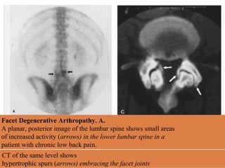 Facet Degenerative Arthropathy. A.
A planar, posterior image of the lumbar spine shows small areas
of increased activity (arrows) in the lower lumbar spine in a
patient with chronic low back pain.
CT of the same level shows
hypertrophic spurs (arrows) embracing the facet joints
 