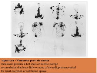 superscan - Numerous prostate cancer
metastases produce â hot spots of intense isotope
accumulation that leave little or none of the radiopharmaceutical
for renal excretion or soft tissue uptake.
 