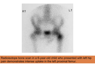 Radioisotope bone scan in a 6-year-old child who presented with left hip
pain demonstrates intense uptake in the left proximal femur.
 