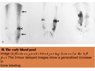 B. The early blood pool
image (le ft) sho ws g re ate r blo o d po o ling (arro ws) in the le ft
fo o t. The 3-hour delayed images show a generalized increase
in
bone labeling.
 