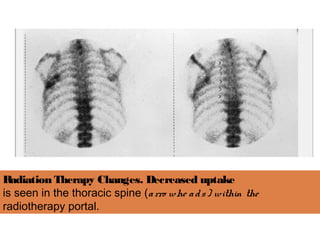 Radiation Therapy Changes. Decreased uptake
is seen in the thoracic spine (arro whe ads) within the
radiotherapy portal.
 