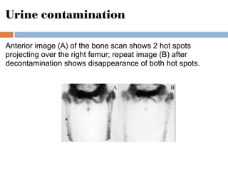 Urine contamination
Anterior image (A) of the bone scan shows 2 hot spots
projecting over the right femur; repeat image (B) after
decontamination shows disappearance of both hot spots.
 