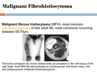 Malignant Fibrohistiocytoma
Malignant fibrous histiocytoma (MFH) -most common
soft tissue sarcoma of late adult life, most commonly occurring
between 50-70yrs.
The bone scintigram (A) shows radionuclide accumulation in the soft tissue of the
right thigh. Axial MRI (B) demonstrates an intramuscular soft tissue mass, that
was biopsy-proven malignatn fibrohistiocytoma.
 