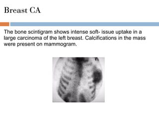 Breast CA
The bone scintigram shows intense soft- issue uptake in a
large carcinoma of the left breast. Calcifications in the mass
were present on mammogram.
 