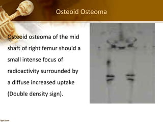 Osteoid Osteoma
Osteoid osteoma of the mid
shaft of right femur should a
small intense focus of
radioactivity surrounded by
a diffuse increased uptake
(Double density sign).
 