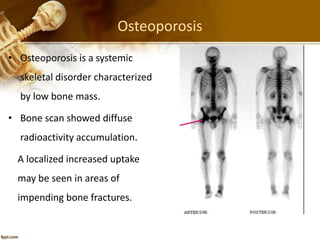 Osteoporosis
• Osteoporosis is a systemic
skeletal disorder characterized
by low bone mass.
• Bone scan showed diffuse
radioactivity accumulation.
A localized increased uptake
may be seen in areas of
impending bone fractures.
 
