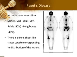 Paget’s Disease
• Increase bone resorption.
• Spine (75%) - Skull (65%) -
Pelvis (40%) - Long bones
(40%).
• There is dense, sheet like
tracer uptake corresponding
to distribution of the lesions.
 
