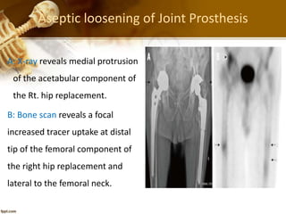 Aseptic loosening of Joint Prosthesis
A: X-ray reveals medial protrusion
of the acetabular component of
the Rt. hip replacement.
B: Bone scan reveals a focal
increased tracer uptake at distal
tip of the femoral component of
the right hip replacement and
lateral to the femoral neck.
 