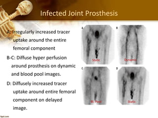 Infected Joint Prosthesis
A: Irregularly increased tracer
uptake around the entire
femoral component
B-C: Diffuse hyper perfusion
around prosthesis on dynamic
and blood pool images.
D: Diffusely increased tracer
uptake around entire femoral
component on delayed
image.
Dynamic
Bl. Pool Static
Static
 