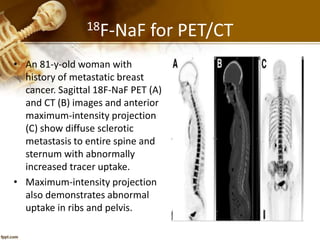 18F-NaF for PET/CT
• An 81-y-old woman with
history of metastatic breast
cancer. Sagittal 18F-NaF PET (A)
and CT (B) images and anterior
maximum-intensity projection
(C) show diffuse sclerotic
metastasis to entire spine and
sternum with abnormally
increased tracer uptake.
• Maximum-intensity projection
also demonstrates abnormal
uptake in ribs and pelvis.
 