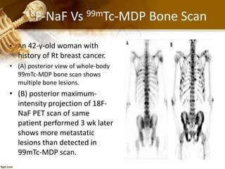 18F-NaF Vs 99mTc-MDP Bone Scan
• An 42-y-old woman with
history of Rt breast cancer.
• (A) posterior view of whole-body
99mTc-MDP bone scan shows
multiple bone lesions.
• (B) posterior maximum-
intensity projection of 18F-
NaF PET scan of same
patient performed 3 wk later
shows more metastatic
lesions than detected in
99mTc-MDP scan.
 