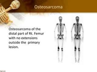 Osteosarcoma
Osteosarcoma of the
distal part of Rt. Femur
with no extensions
outside the primary
lesion.
 