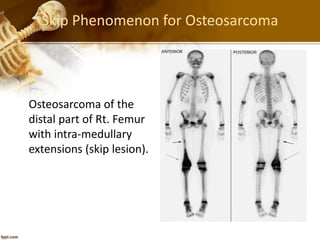 Skip Phenomenon for Osteosarcoma
Osteosarcoma of the
distal part of Rt. Femur
with intra-medullary
extensions (skip lesion).
 