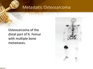 Metastatic Osteosarcoma
Osteosarcoma of the
distal part of lt. Femur
with multiple bone
metastases.
 