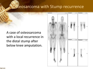Osteosarcoma with Stump recurrence
A case of osteosarcoma
with a local recurrence in
the distal stump after
below knee amputation.
 