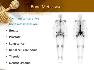 Bone Metastases
• Common cancers give
bone metastases are:
• Breast
• Prostate
• Lung cancer
• Renal cell carcinoma
• Thyroid
• Neuroblastoma
 