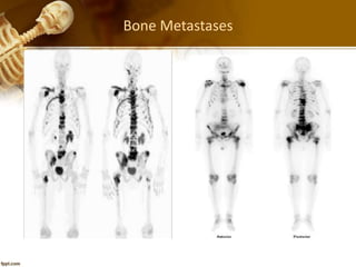 Bone Metastases
 