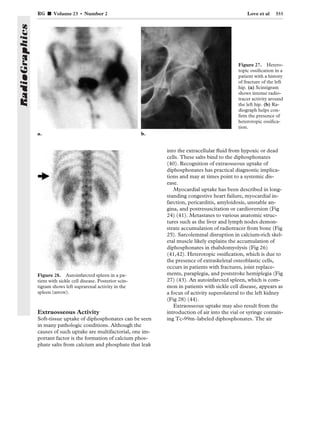A detailed review of bone scintigraphy using Tc-99m, covering normal ...