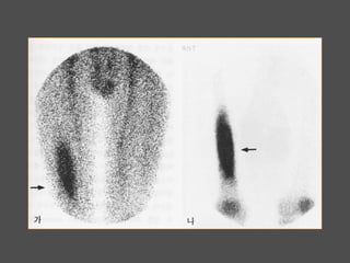 Use of bone scan in musculoskeletal disease | PPTX