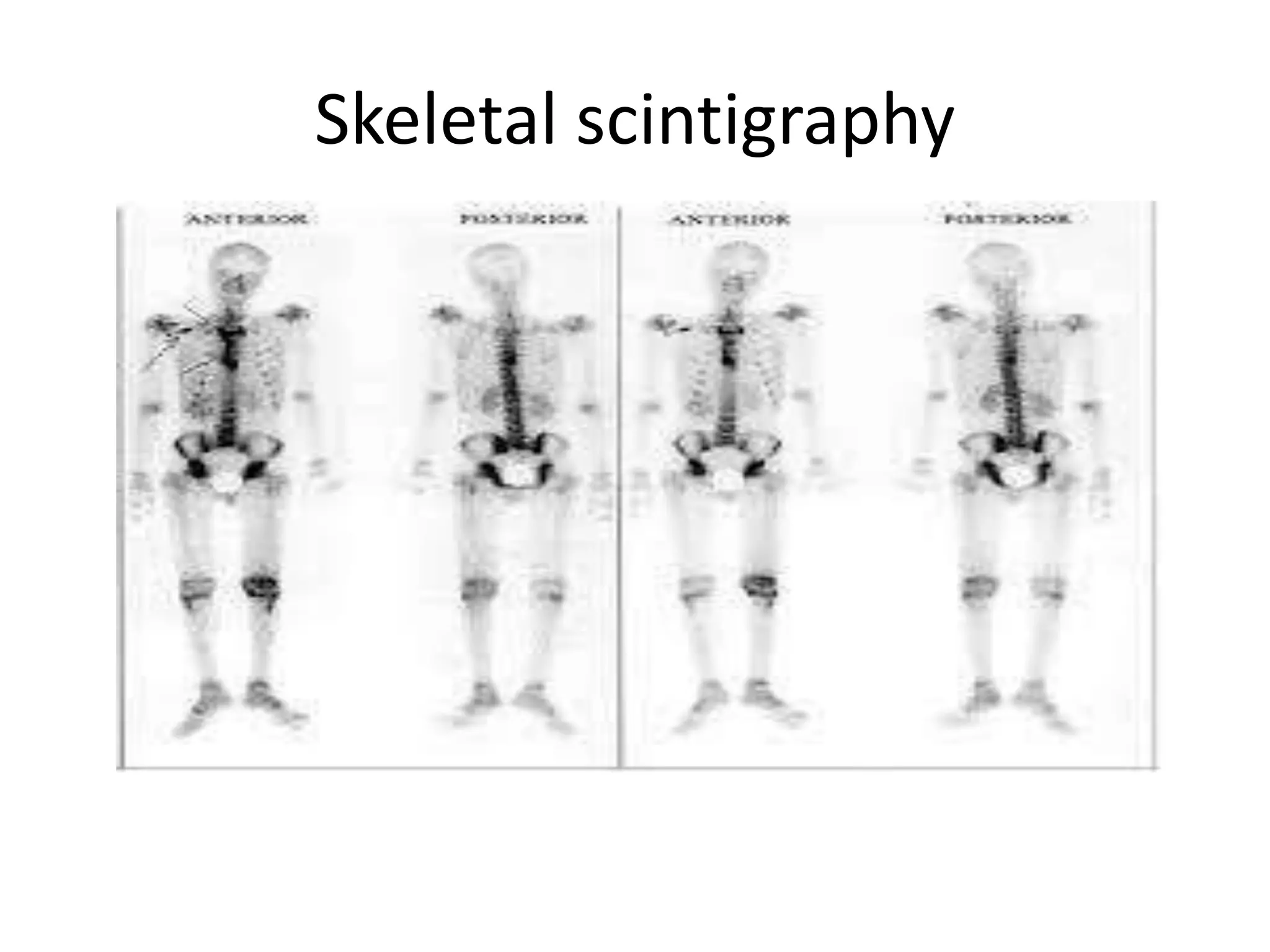 bone scan by Dr.Madeeha.pptx